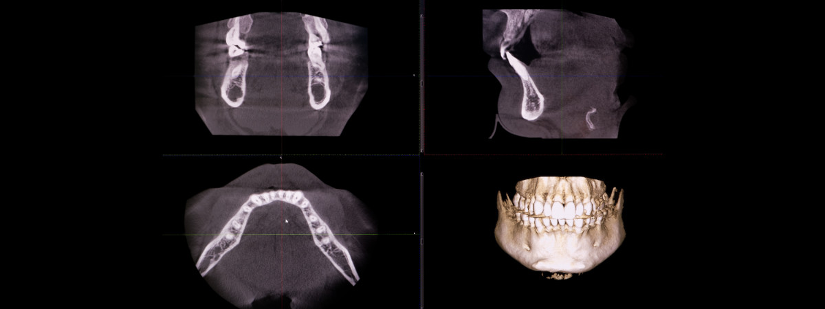 CT snimka zuba