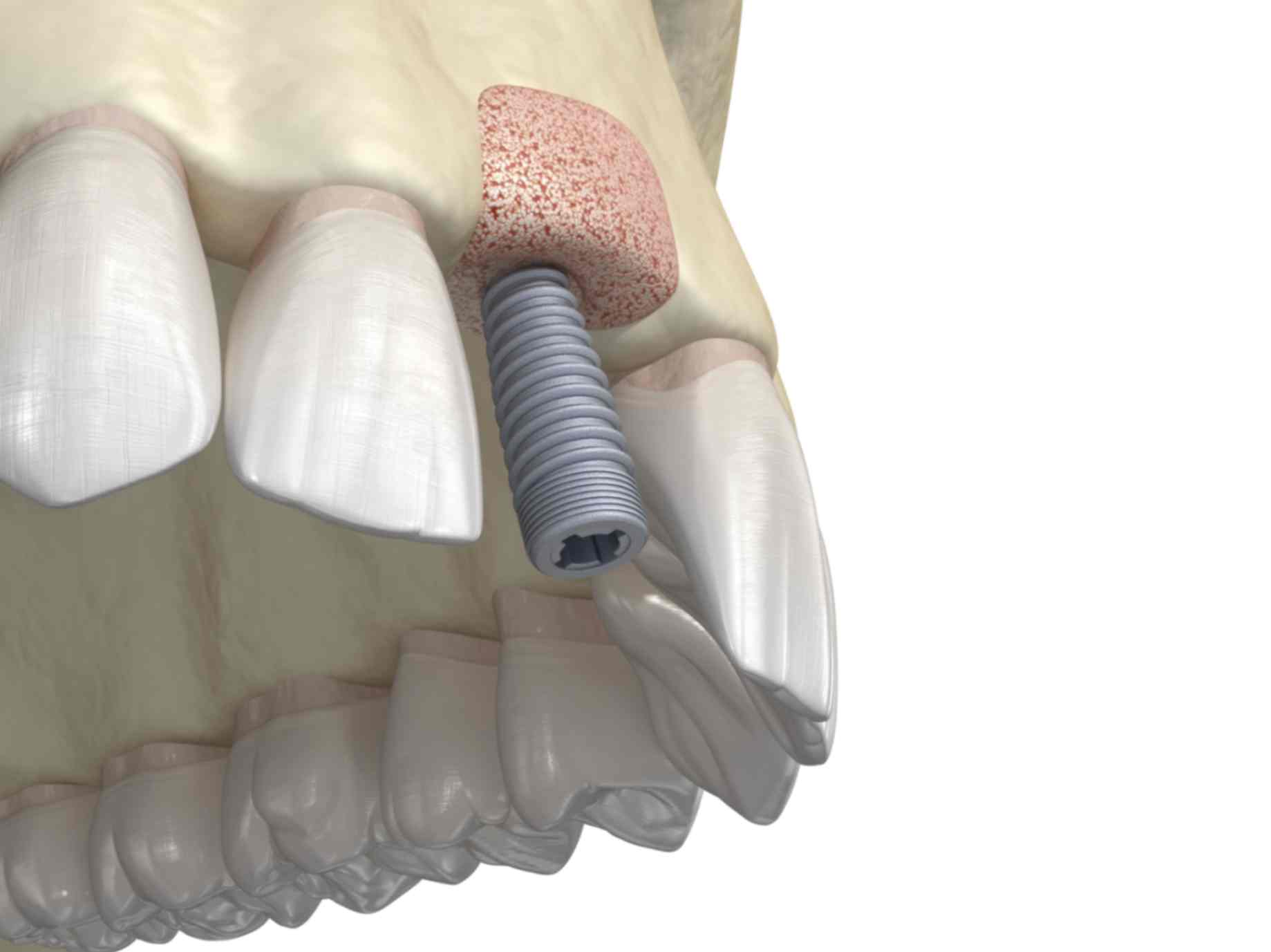 dodavanje umjetne kosti za ugradnju implantata