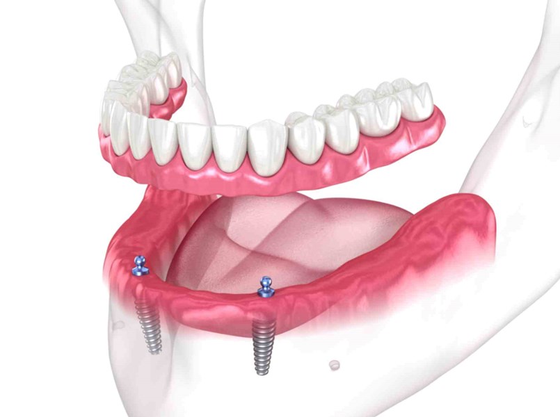 zubna proteza na dva implantata u donjoj čeljusti