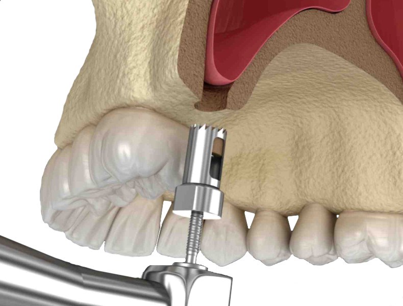 sinus lift