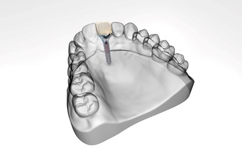 dentalni implantati